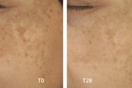 your skin_pigmentbio_c-concentrate_before-after