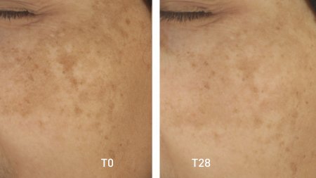 your skin_pigmentbio_c-concentrate_before-after your skin_pigmentbio_c-concentrate_before-after